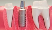 Отзывы об имплантах зубов