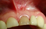 Опасности радикулярной кисты зуба