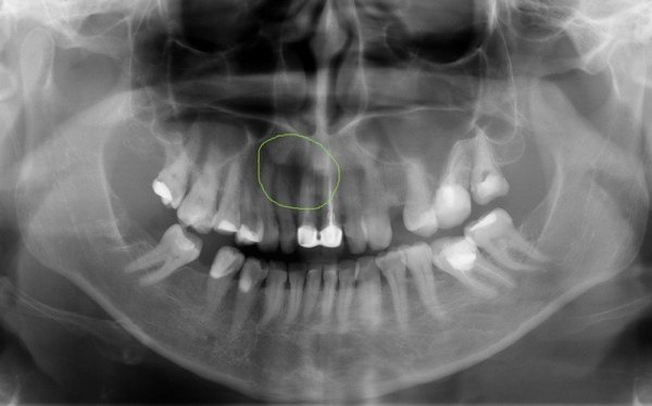 Радикулярная киста на снимке