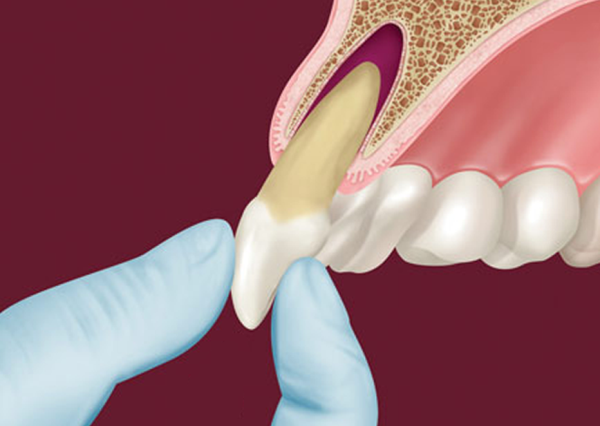 Реплантация зуба показания и противопоказания