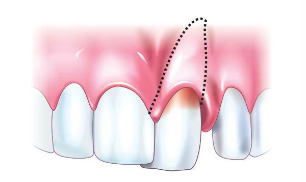 Показания и противопоказания к реплантации зуба