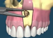 Операция резекции верхушки корня зуба