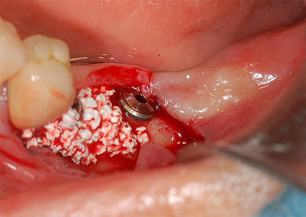 Удаление импланта зуба отзывы