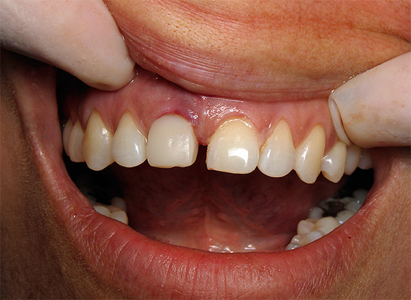 Удаление импланта зуба последствия
