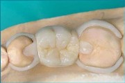 Особенности зубных микропротезов