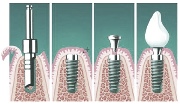 Особенности двухэтапной имплантации зубов