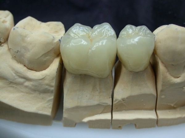 Фарфоровые коронки на передние зубы
