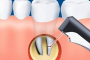 Послеоперационный период резекции корня зуба