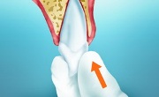 Проведение реплантации зуба