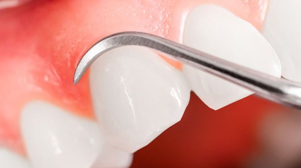 Сколько стоит операция цистэктомии кисты зуба