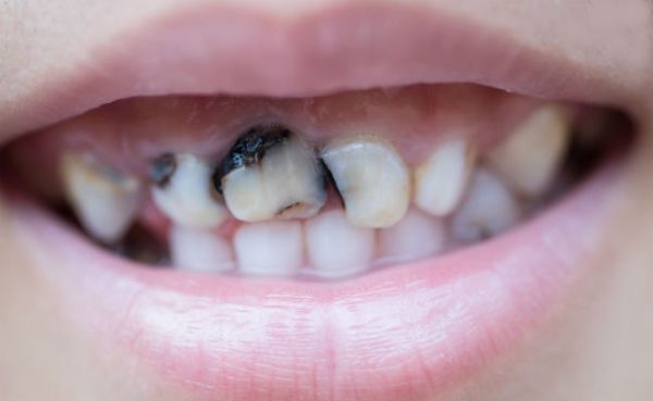 Удаление молочного зуба у детей последствия