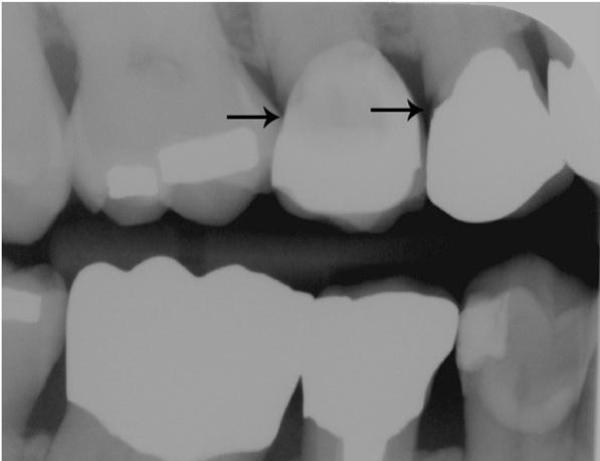 Удлинение коронковой части зуба