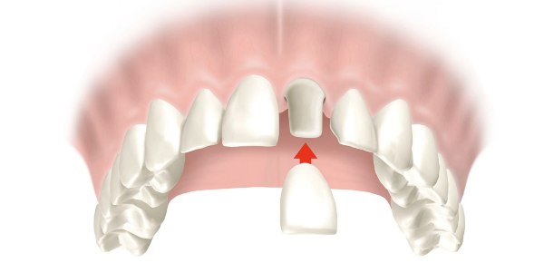 Удлинение передних зубов