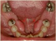 Развитие экзостоза после удаления зуба