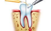 Особенности проведения гемисекции зуба