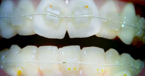 Керамическая брекет система на зубах фото
