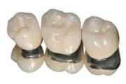 Подготовка зуба к установке металлокерамической коронки Duceram