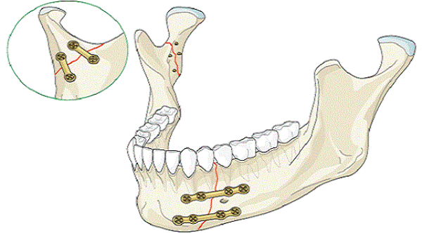Остеосинтез нижней челюсти титановыми пластинами