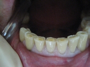 Стирание зубов