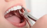 Как удаляют подвижный зуб