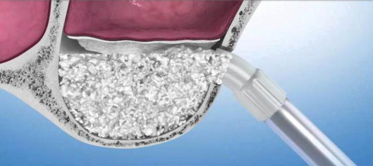 что такое синус лифтинг при имплантации зубов и его разновидности