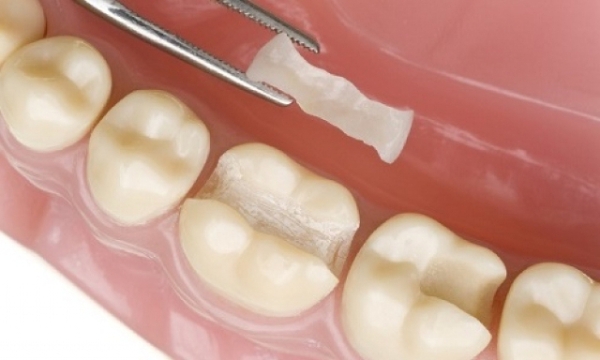 Керамическая вкладка на зуб плюсы и минусы