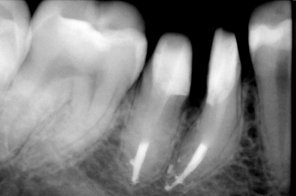 Коронорадикулярная сепарация зуба