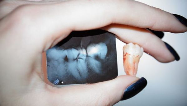 Лазерное удаление кисты зуба