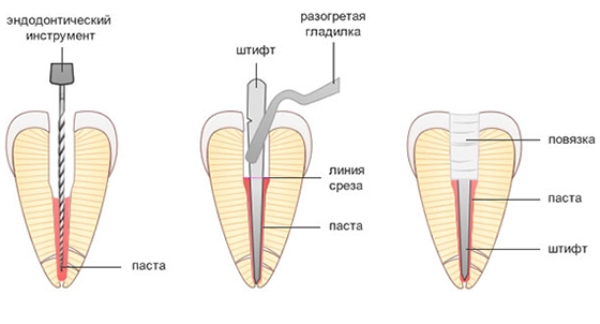 Болит зуб после перелечивания каналов