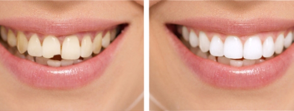 Художественная реставрация и моделирование передних зубов