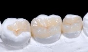 керамическая вкладка на зуб плюсы