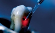 Лазерное удаление кисты зуба