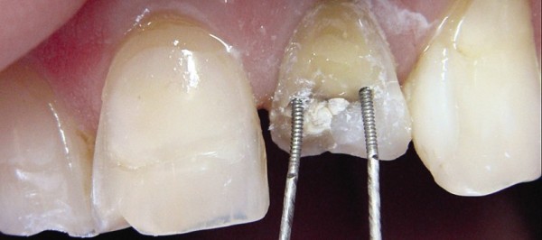 Методика реставрации зуба с помощью парапульпарного штифта