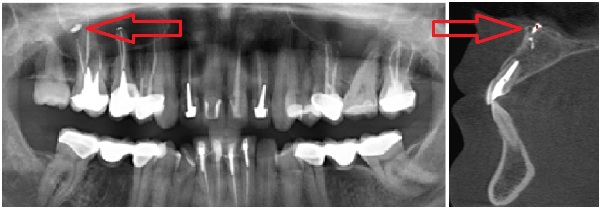 Перелечивание каналов зуба болит