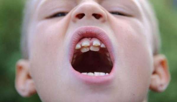 Сверхкомплектные зубы у детей фото