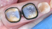 Ретракционная нить в стоматологии