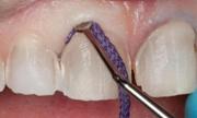 Виды ретракционных нитей в стоматологии