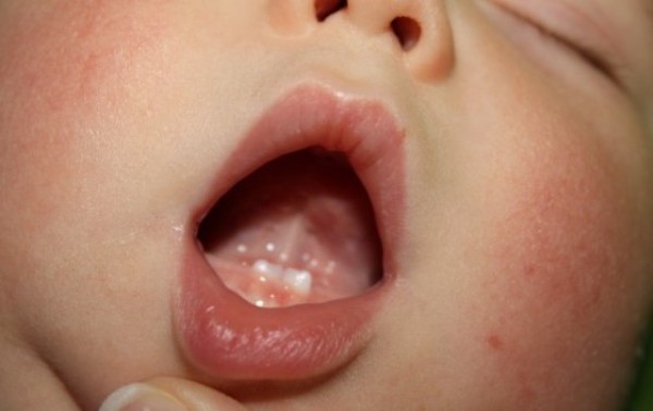 Удаление сверхкомплектного зуба у ребенка