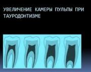 Зубы при тауродонтизме