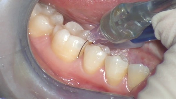Техника интралигаментарной анестезии в стоматологии