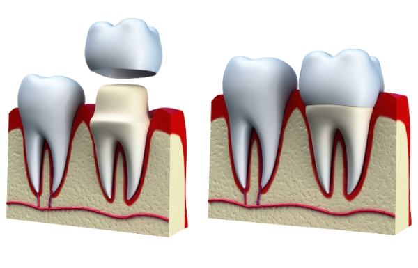 Трещины на зубной эмали лечение