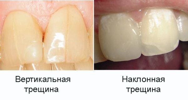 Трещина эмали на переднем зубе