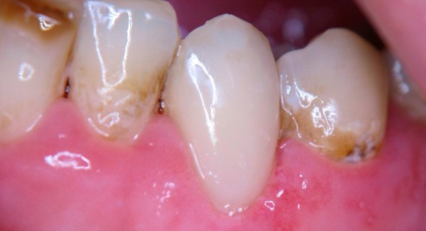 Ретракционная нить в стоматологии