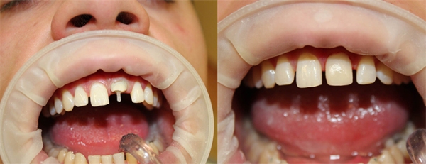 Восстановление коронки зуба стекловолоконным штифтом