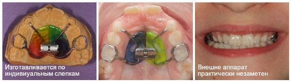 Аппарат хааса ортодонтия фото