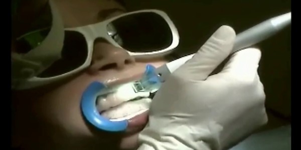 Безопасное отбеливание зубов диодный лазер Doctor Smile