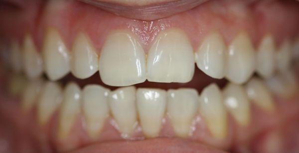 Double White отбеливание отзывы