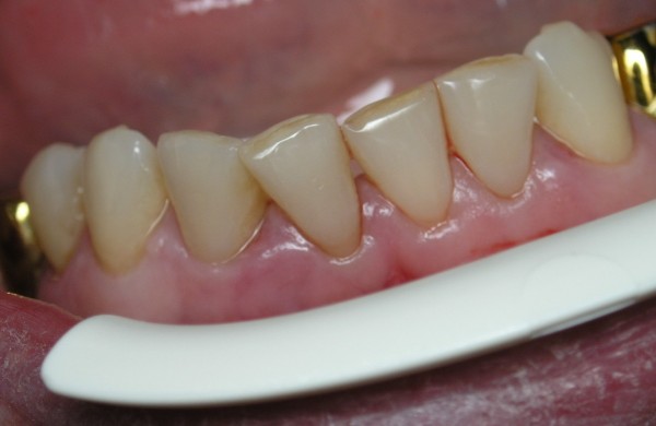 Десенситайзеры в стоматологии классификация