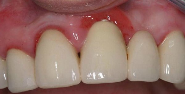Коагуляция десны в стоматологии