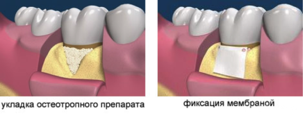 Коллагеновая мембрана в стоматологии цена